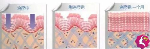 用热玛吉祛除皱纹的手术原理 用热玛吉祛除皱纹的手术原理