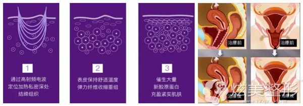 射频私密抗衰回春术 射频私密抗衰回春术
