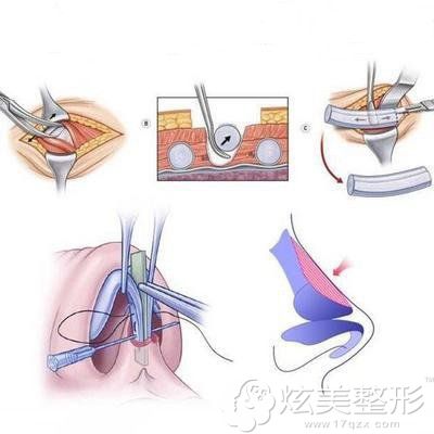 采用肋软骨隆鼻的手术原理图 采用肋软骨隆鼻的手术原理图