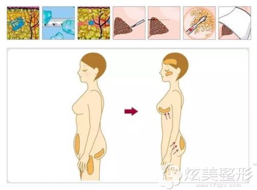 水动力分层吸脂瘦腰腹 水动力分层吸脂瘦腰腹