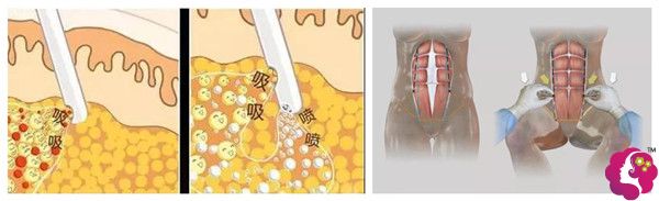 抽脂和腹壁成型术同时进行 抽脂和腹壁成型术同时进行