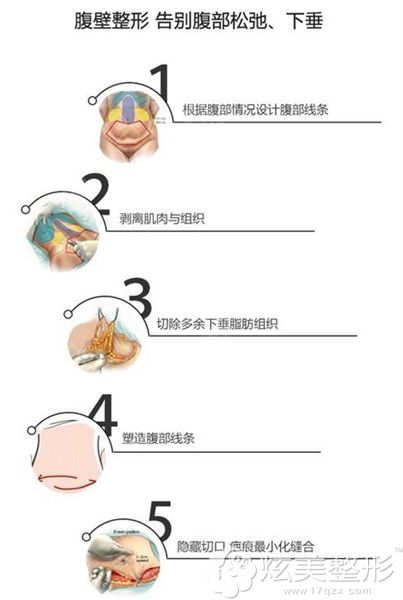 腹壁成型术过程 腹壁成型术过程
