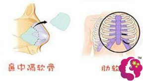 隆鼻所用的鼻中隔软骨和肋软骨 隆鼻所用的鼻中隔软骨和肋软骨