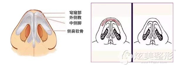 耳软骨垫鼻尖效果对比 耳软骨垫鼻尖效果对比