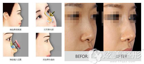 耳软骨隆鼻效果图 耳软骨隆鼻效果图