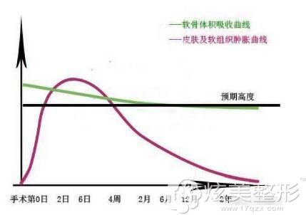 自体软骨隆鼻的吸收曲线变化 自体软骨隆鼻的吸收曲线变化