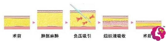 大腿抽脂和腰腹抽脂情况 大腿抽脂和腰腹抽脂情况