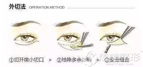 外切去眼袋的手术原理图示 外切去眼袋的手术原理图示