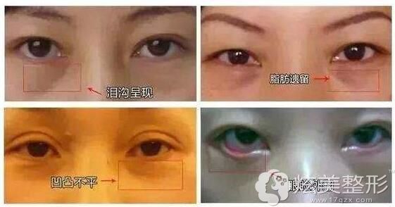 去眼袋有可能出现的后遗症 去眼袋有可能出现的后遗症