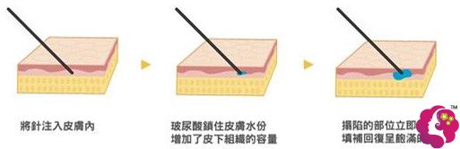 铜仁华美整形医生张晓伟做注射微整形 铜仁华美整形医生张晓伟做注射微整形