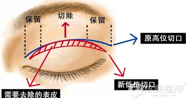 双眼皮眼头分叉褶皱的修复方法 双眼皮眼头分叉褶皱的修复方法