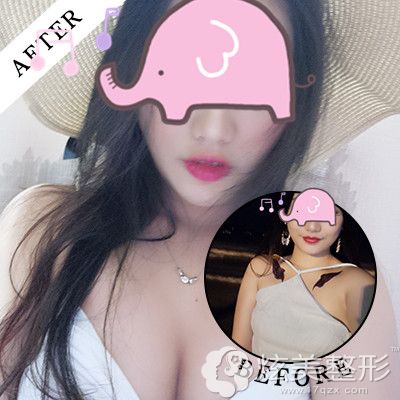 采用娜绮丽假体隆胸手术案例对比 采用娜绮丽假体隆胸手术案例对比