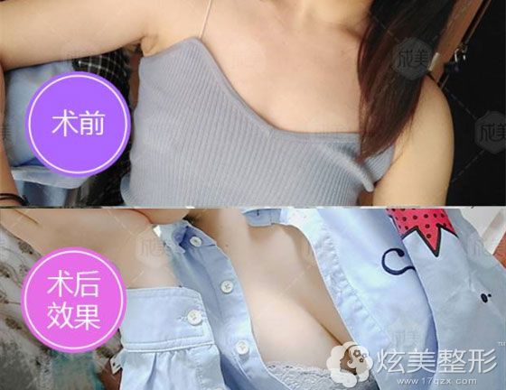 成都整形美容医院做的曼托隆胸前后对比照 成都整形美容医院做的曼托隆胸前后对比照