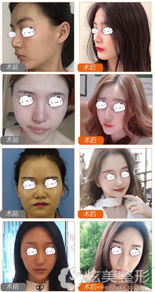 孙明磊医生隆鼻案例图 孙明磊医生隆鼻案例图
