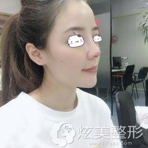 孙明磊医生隆鼻七天后拆线 孙明磊医生隆鼻七天后拆线