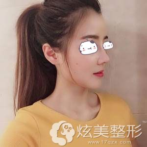 隆鼻恢复三十天的效果图 隆鼻恢复三十天的效果图