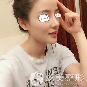 找孙明磊医生做完隆鼻后效果 找孙明磊医生做完隆鼻后效果