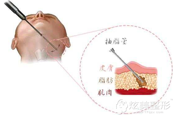 面部吸脂的手术原理 面部吸脂的手术原理
