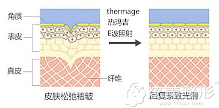 做热玛吉可以改善皮肤的松弛 做热玛吉可以改善皮肤的松弛