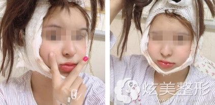 做下颌角和颧骨手术第二天面部肿胀 做下颌角和颧骨手术第二天面部肿胀