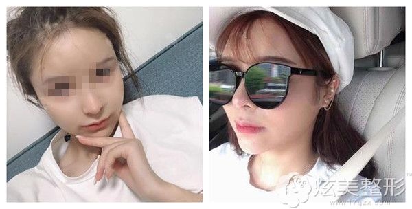 在美恩整形做颧骨和下颌角手术恢复自然 在美恩整形做颧骨和下颌角手术恢复自然