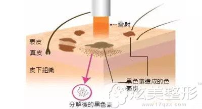 李芳芳医生做激光祛斑手术 李芳芳医生做激光祛斑手术