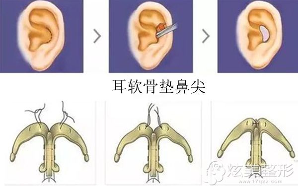 采用耳软骨垫鼻尖改善朝天鼻 采用耳软骨垫鼻尖改善朝天鼻