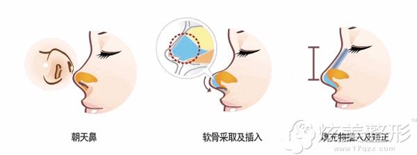 鼻综合手术综合改善朝天鼻 鼻综合手术综合改善朝天鼻