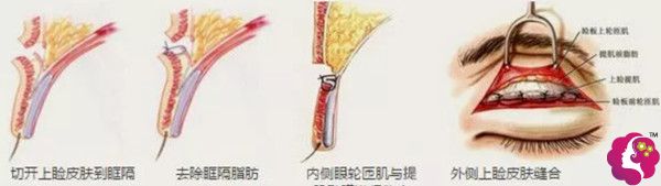 Park双眼皮手术缝两层以上 Park双眼皮手术缝两层以上