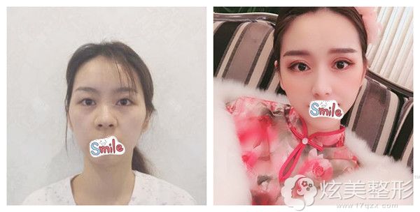 park法双眼皮效果自然无痕 park法双眼皮效果自然无痕