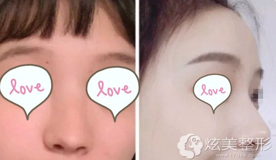 蒜鼻头做鼻综合术后改善效果明显 蒜鼻头做鼻综合术后改善效果明显