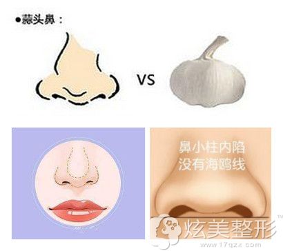 蒜头鼻的问题不仅仅是鼻头大还有塌鼻梁 蒜头鼻的问题不仅仅是鼻头大还有塌鼻梁