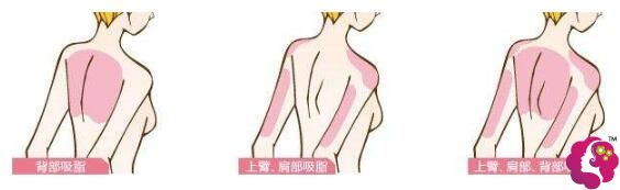 胳膊吸脂大臂小臂可以一起做 胳膊吸脂大臂小臂可以一起做