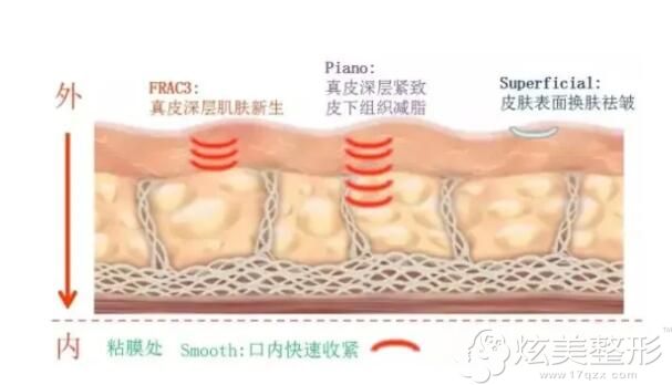 欧洲之星fotona 4D pro抗衰原理 欧洲之星fotona 4D pro抗衰原理