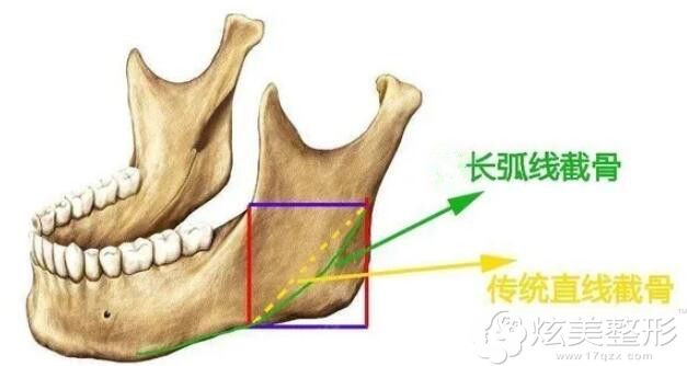 下颌骨长曲线截骨示意图来看：u型截骨和长曲线的区别