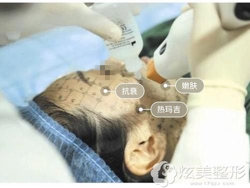 医生操作热玛吉要求高 医生操作热玛吉要求高