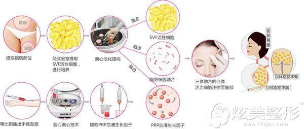 采用悬吊和自体脂肪改善萎缩下垂的乳房 采用悬吊和自体脂肪改善萎缩下垂的乳房