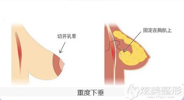 乳房悬吊术中的双环法原理 乳房悬吊术中的双环法原理