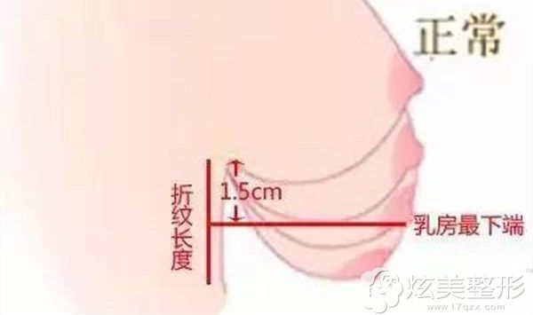 常见的乳房下垂程度 常见的乳房下垂程度