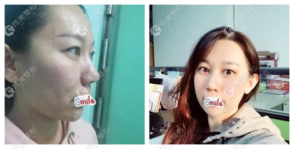 40多岁做螺旋线效果对比 40多岁做螺旋线效果对比