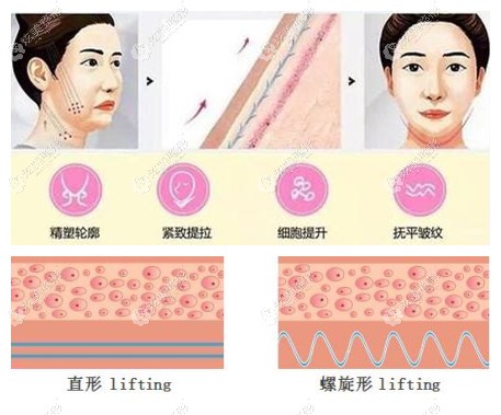 意大利悦升螺旋线适合人群 意大利悦升螺旋线适合人群