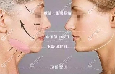 意大利悦升线提升面部 意大利悦升线提升面部
