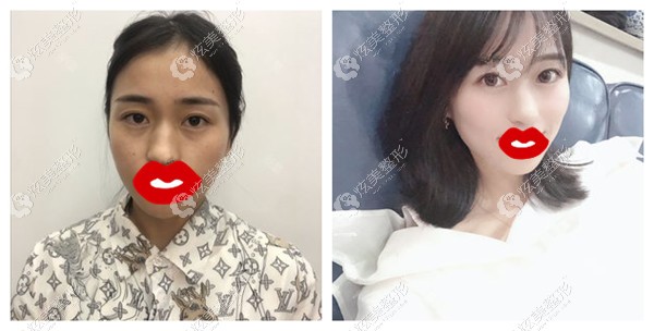 热玛吉做全面部除皱效果对比 热玛吉做全面部除皱效果对比