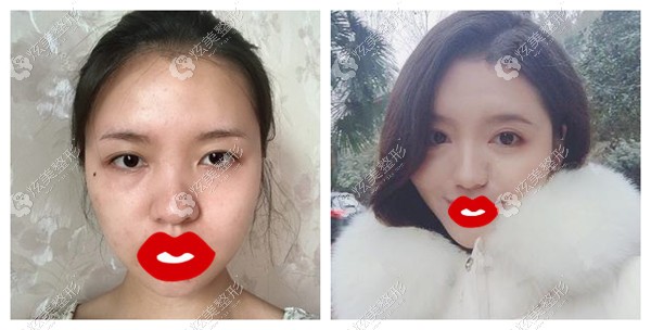 悦升线提升效果对比 悦升线提升效果对比