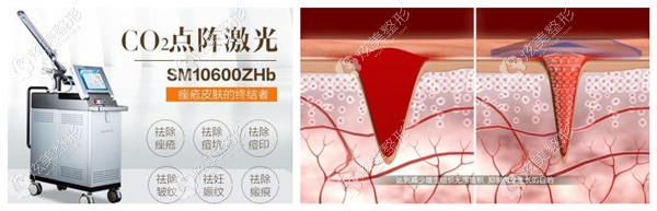 二氧化碳激光祛疤 二氧化碳激光祛疤