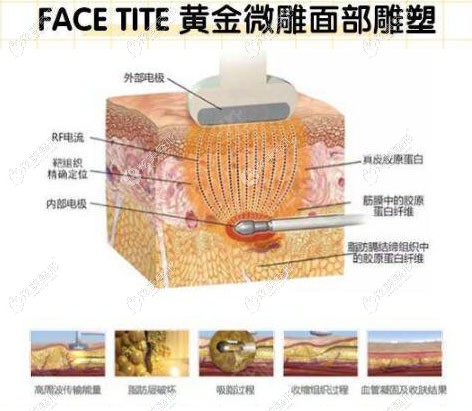 黄金微雕射频溶脂原理 黄金微雕射频溶脂原理