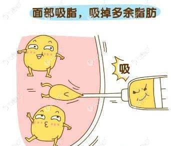 面部吸脂改善脸大价格贵不 面部吸脂改善脸大价格贵不