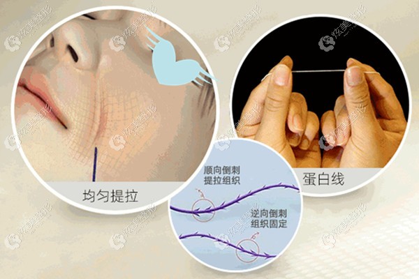 韩国美迪塑大V线提升下垂的苹果肌 韩国美迪塑大V线提升下垂的苹果肌