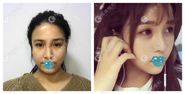 美迪塑大V线提升苹果肌效果对比 美迪塑大V线提升苹果肌效果对比