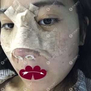 刚做完雨沙假体隆鼻术后鼻子微肿 刚做完雨沙假体隆鼻术后鼻子微肿
